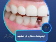 ایمپلنت دندان در مشهد با اقساط بلندمدت و شرایط ویژه